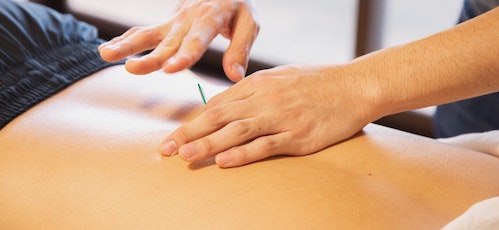 acupuncture physiotherapy etobicoke