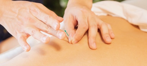 dry needling physiotherapy